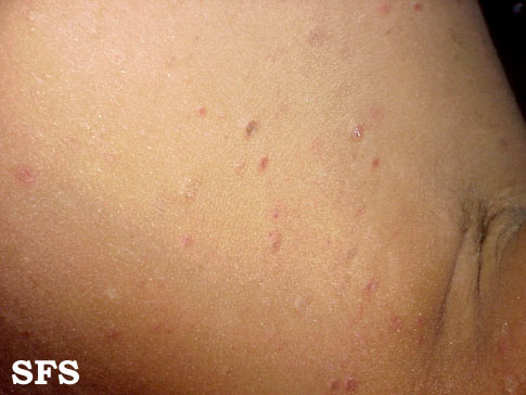 Pityriasis lichenoides chronica. With permission from Dermatology Atlas.[1]