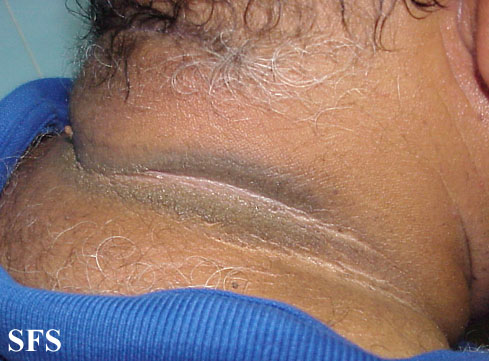 Pseudo-acanthosis nigricans. With permission from Dermatology Atlas.[2]