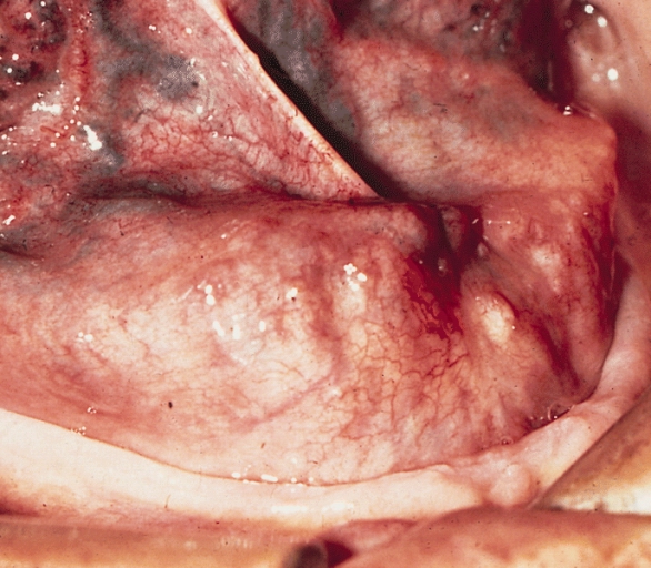 SALIVARY GLANDS: ADENOID CYSTIC CARCINOMA. This sublingual gland tumor slowly enlarged to produce a large, lobulated mass in the anterior floor of the mouth. The oral mucosa is intact.