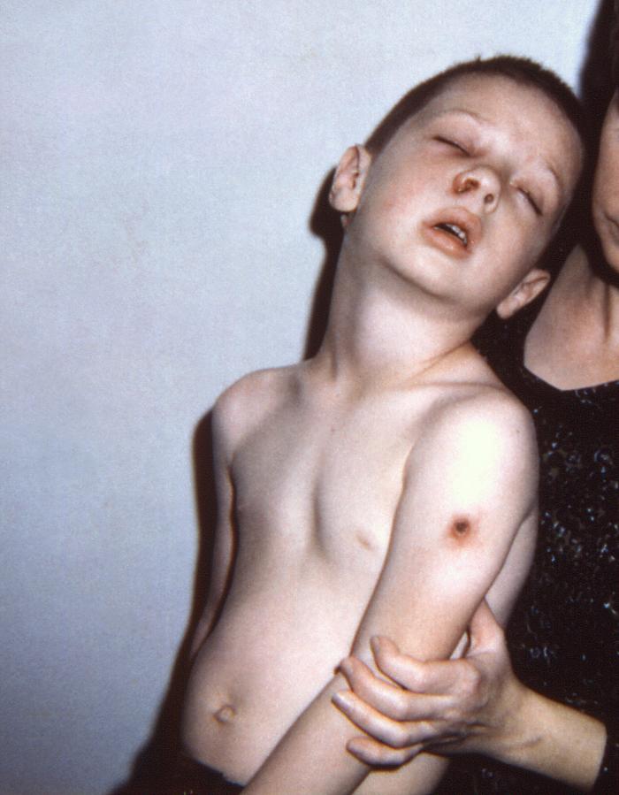 6 year-old child, who after having received a smallpox vaccination, sustained what is termed an “accidental implantation” of the newly-introduced vaccinia virus. Note the erythematous blush over his cheeks, and inflamed nasal lesion, as well as the overall lethargic posture all due to this accidental implantation.Adapted from Public Health Image Library (PHIL), Centers for Disease Control and Prevention.[3]