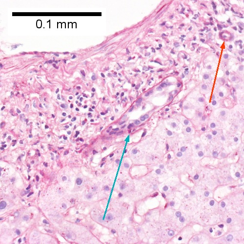 F. A PAS with diastase stain colors the arteriole (red arrow), as well as the rim of the interlobular duct within which lies a neutrophil (cyan arrow).