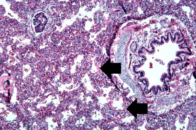 This is a medium-power photomicrograph showing a large bronchus with cartilage. Interstitial congestion with numerous red cells is apparent. Even at this magnification hyaline membranes (arrows) can be seen lining the alveoli.