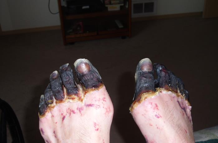 Dorsal view of a 59 year-old man’s feet who had been infected by the plague bacterium, Yersinia pestis, after having come into contact with both an infected cat, and a dead mouse in his neighborhood. Adapted from Public Health Image Library (PHIL), Centers for Disease Control and Prevention.[2]