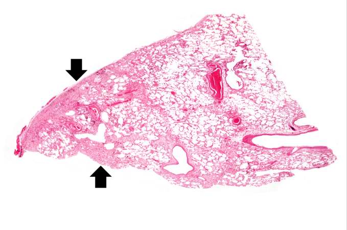 This is a low-power photomicrograph of lung section. Note the thickening of the alveolar septa (arrows).