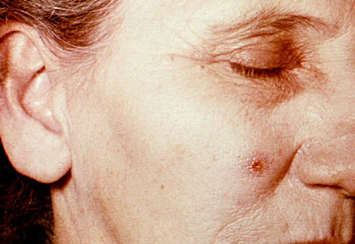 "Anthrax, skin of face, 4th day”Adapted from Public Health Image Library (PHIL), Centers for Disease Control and Prevention.[21]
