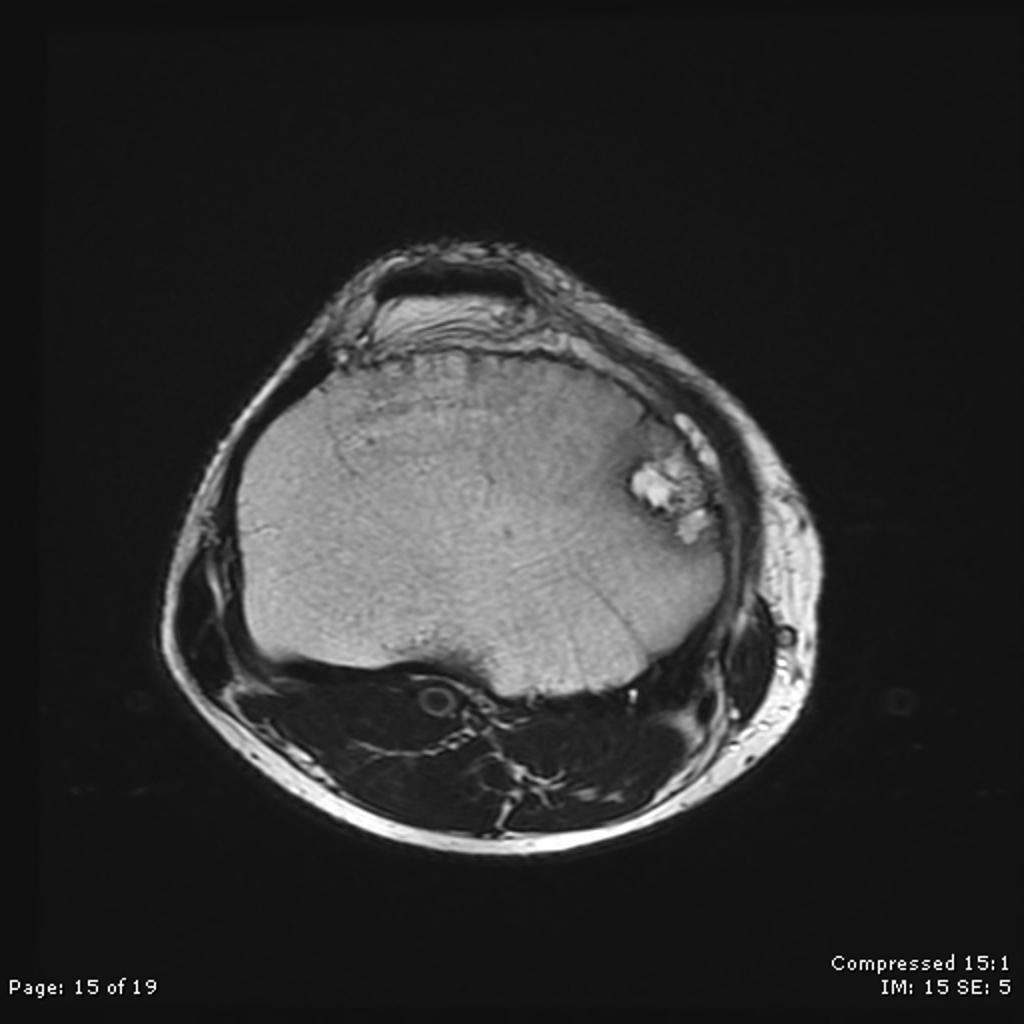 File:MRI CHondroblastoma.jpg