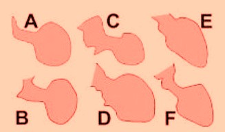 Different end-systolic left ventricular (LV) silhouettes. A, [22]; B, [23]; C, [24]; D, [25]; E, [26]; and F, [27]. There is wide heterogeneity among the different patterns, varying from a relatively small akinetic apical area in C to a wide global akinesia in D and E. [28]