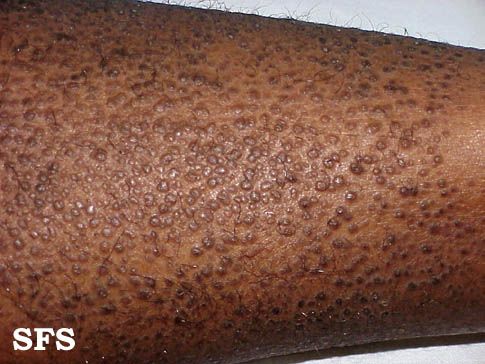 File:Lichen amyloidosus06.jpg