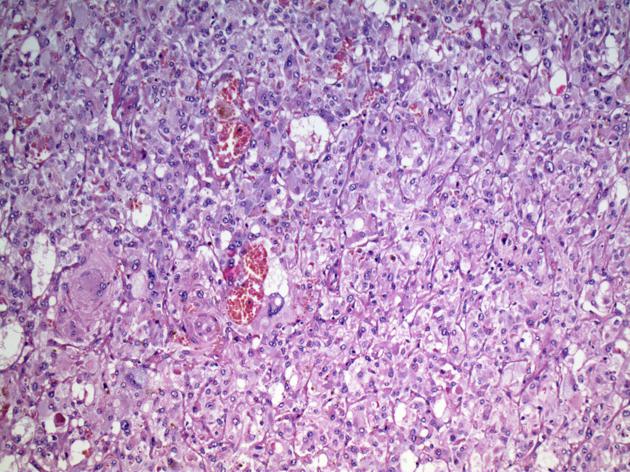 Pheochromocytoma, Case courtesy of Dr Andrew Ryan, Radiopaedia.org From the case <a href="http://radiopaedia.org/cases/22683">rID: 22683