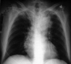 Chest x ray of the same patient the day of admission for aortic dissection showing a new widened mediastinum
