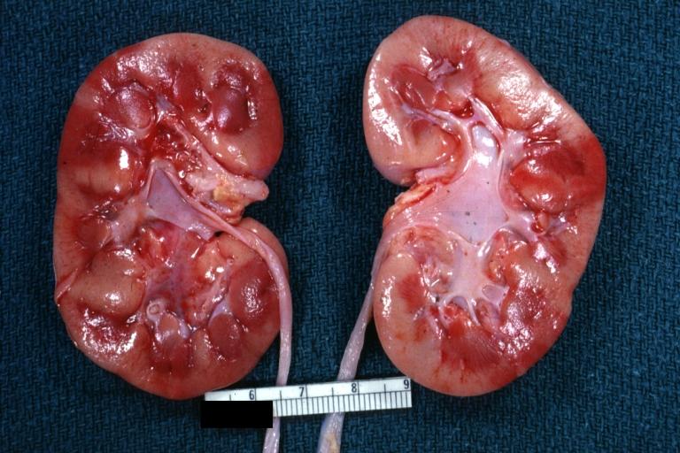Kidney: Acute Tubular Necrosis: Gross good example swollen cortex secondary to body burn