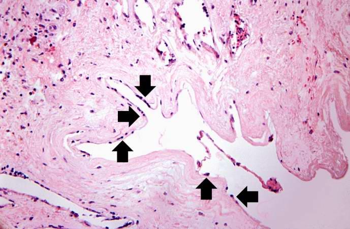 This is a high-power photomicrograph of the luminal surface of a re-canalized vessel. Note that the vessel lumen is lined by endothelial cells (arrows).