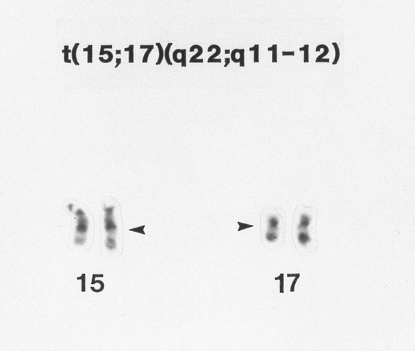 Hypergranular acute promyelocytic leukemia (AML-M3) G-banded Wright-Giemsa stained partial karyotype showing the 15;17 chromosome translocation. The breakpoints on the abnormal chromosomes are designated by arrowheads.