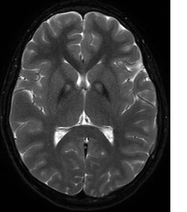 File:Pkan-basal-ganglia-MRI.JPG