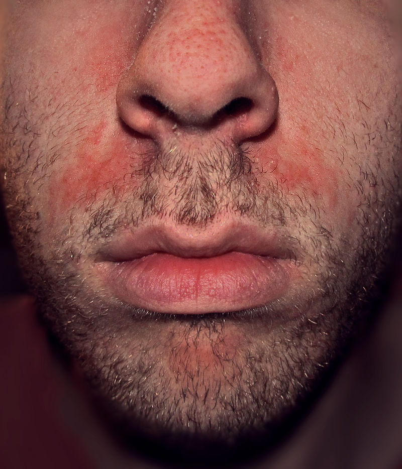 Seborrheic dermatitis showing erythema on face.