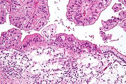 File:256px-Mucinous lmp ovarian tumour intermed mag.jpg