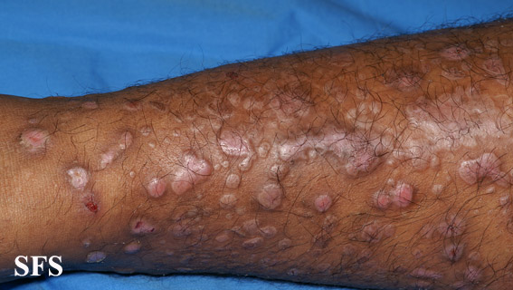 File:Epidermolysis bullosa pruriginosa26.jpg