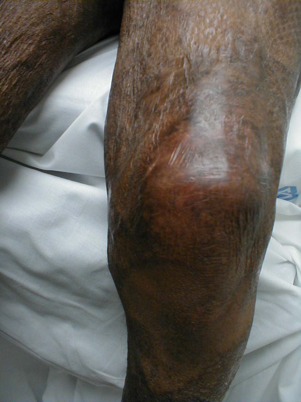 knee gout pictures