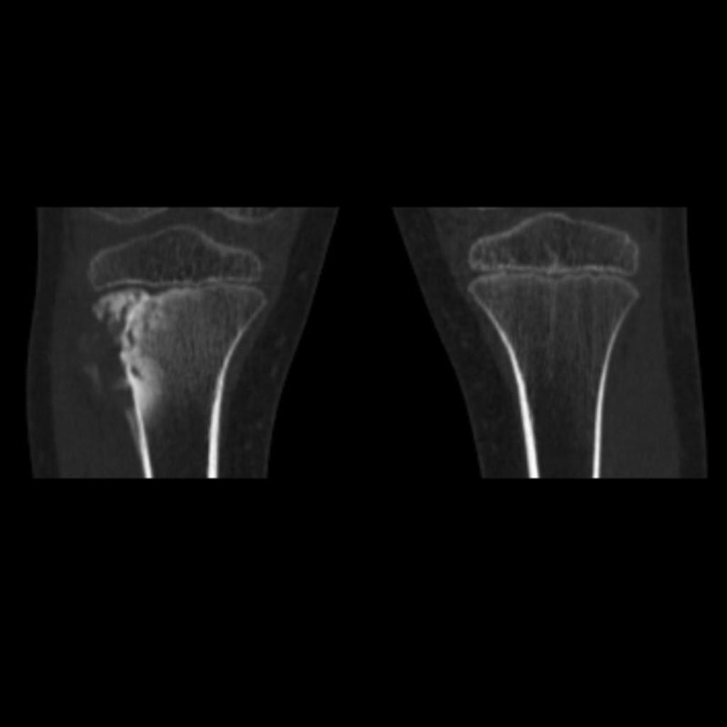 File:Osteosarcoma-tibia Coronal bone window.jpg