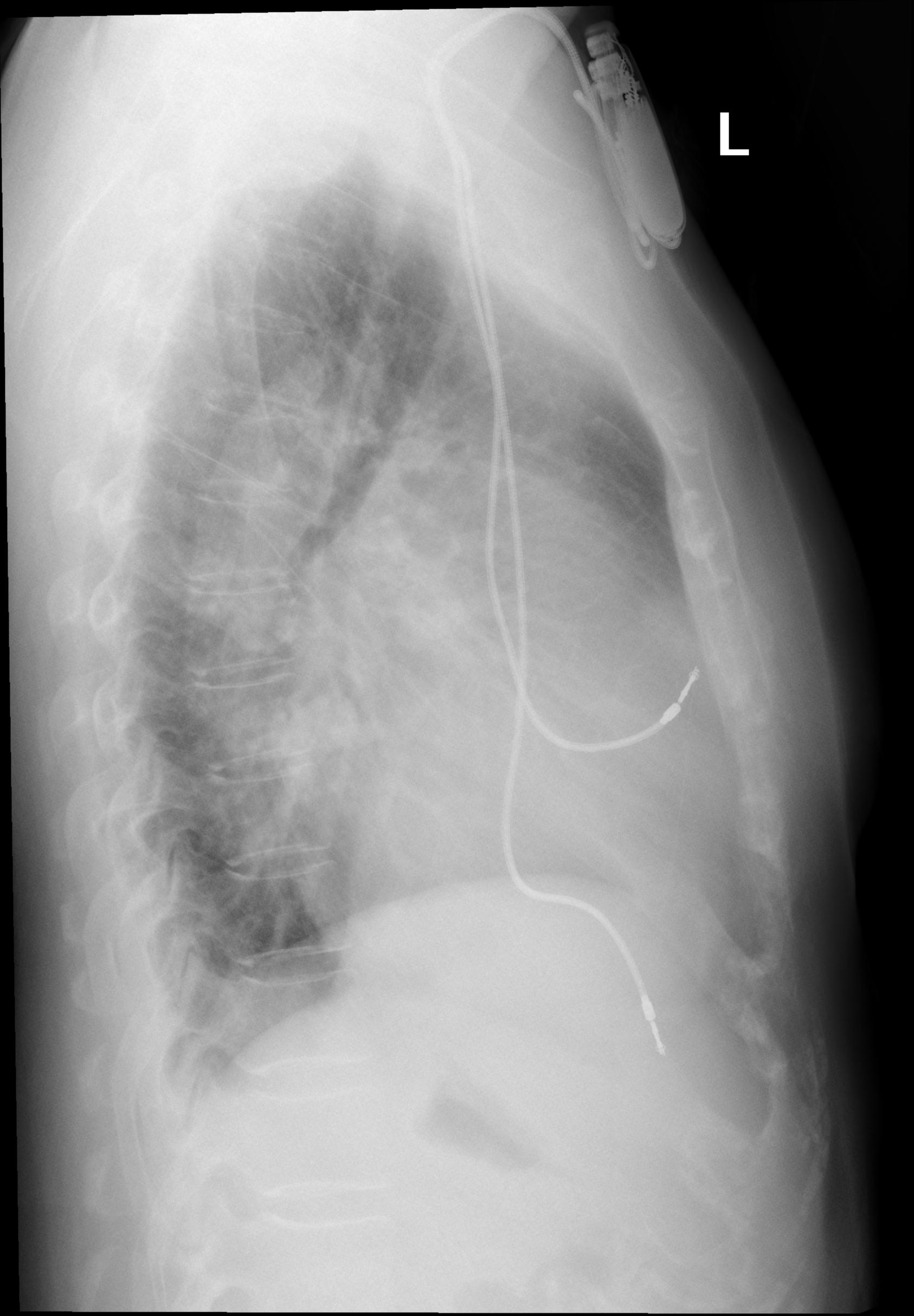 Right-atrial-enlargement lateral view