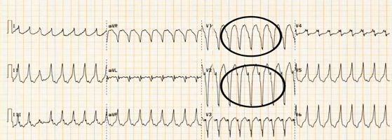 Right ventricular outflow tract ventricular tachycardia. Note the negative deflection in V1 and V2 and left bundle branch block pattern to the tachycardia