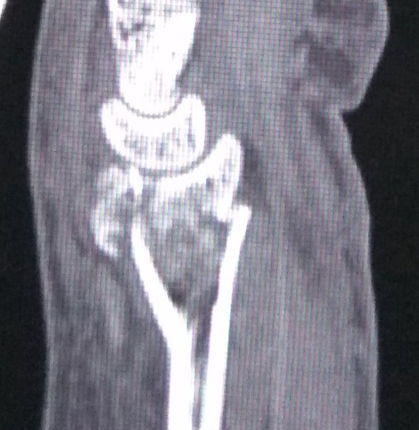 File:CT scan Lateral View with intraarticular step.JPG