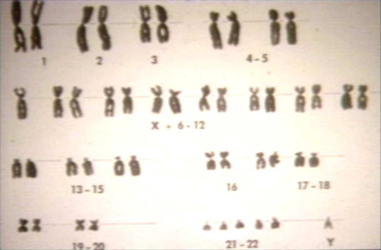 Down syndrome karyotype