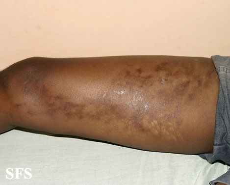 Linear scleroderma. Adapted from Dermatology Atlas.[12]