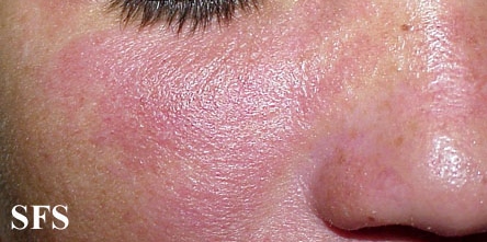 File:Nail polish dermatitis10.jpg
