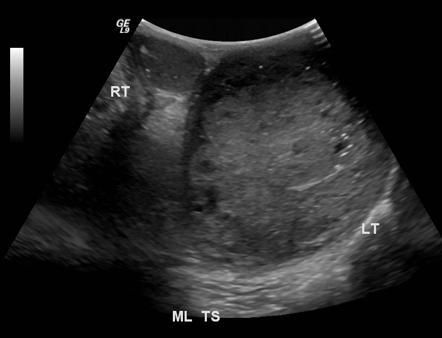 File:Ultrasound choriocarcinoma.gif