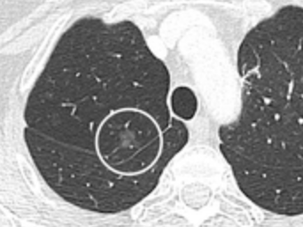 File:CT of ground glass lung nodule.png
