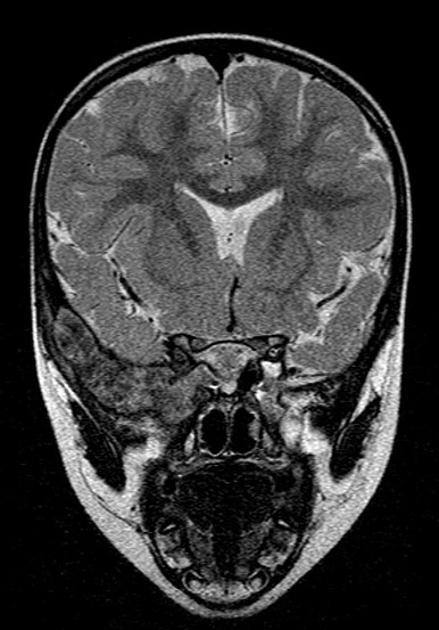 File:Langerhans MRI.jpg
