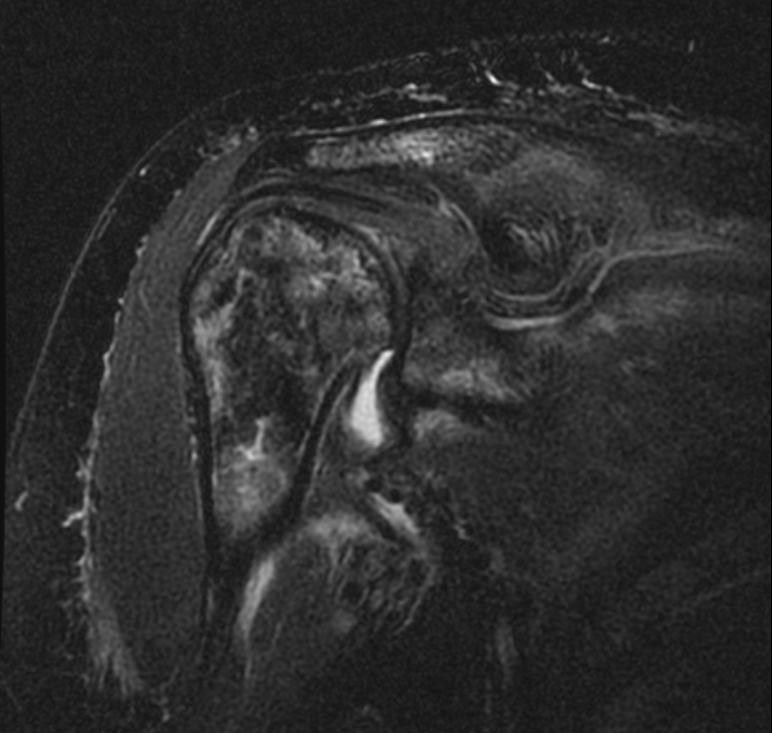 File:Radiation necrosis MRI 002.jpg