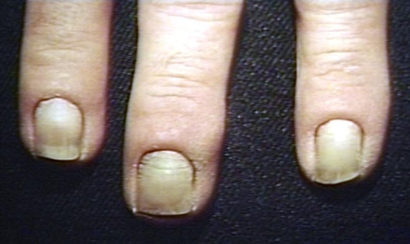 Secondary atherosclerosis caused nail disorders.