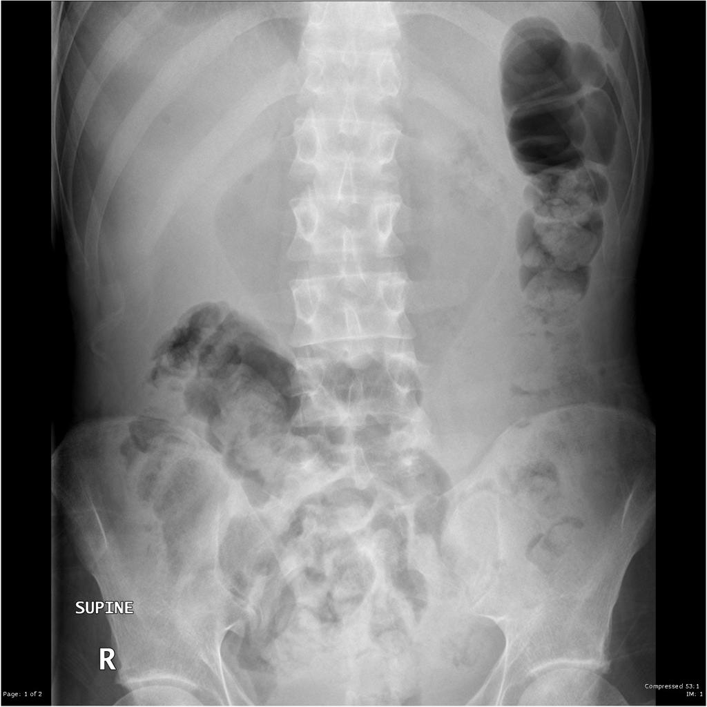 File:Perforated-gastric-ulcer.jpg