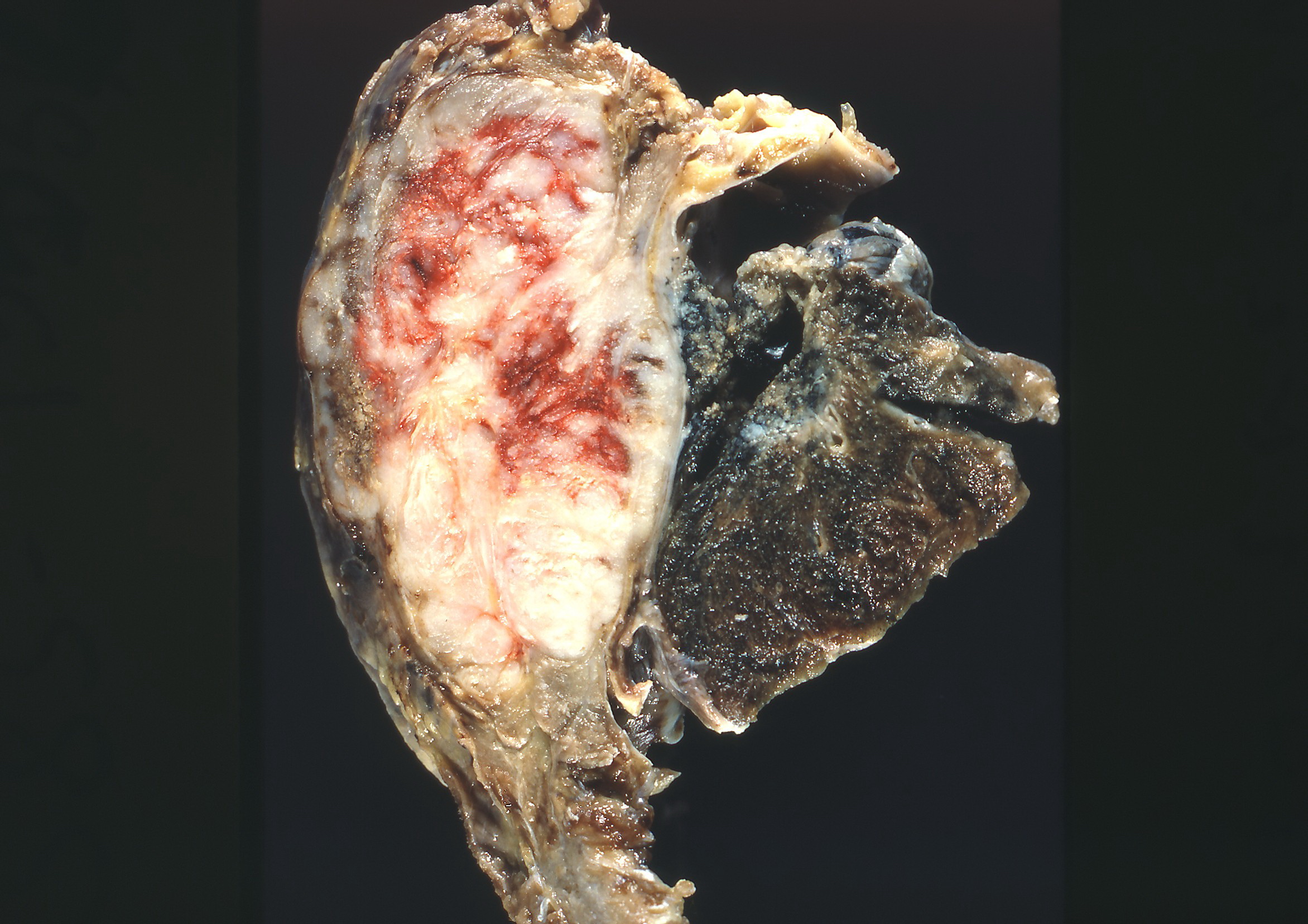 Gross pathology: adenocarcinoma of the lung