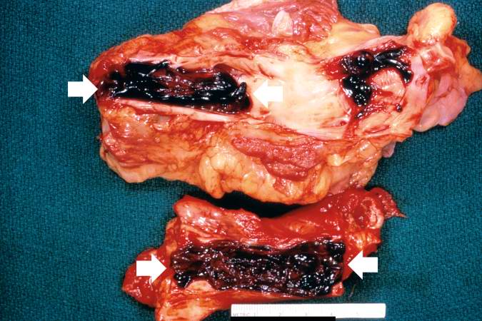 This is a gross photograph of portions of muscle from the legs including sections of leg veins. Note that the leg veins contain thrombus (arrows).