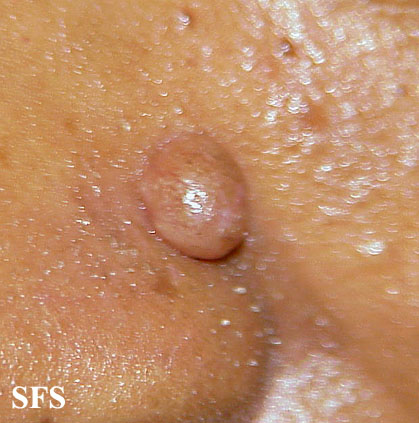 Trichofoliculoma. Adapted from Dermatology Atlas.[3]