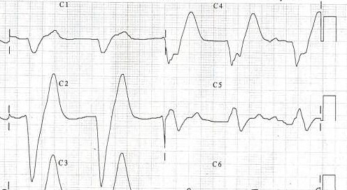 A patient's EKG with hyperkalemia.
