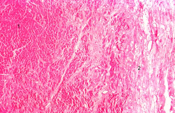 This is a low-power photomicrograph of a healed myocardial infarction with a fibrous scar. Remaining normal tissue is on the left (1) and the fibrous connective tissue scar is on the right (2).