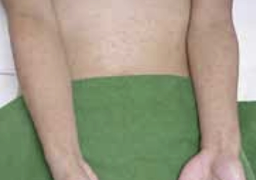 Maculopapular rash in trunk and extremities