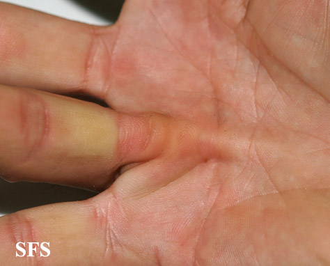 Dupuytren contracture. Adapted from Dermatology Atlas.[6]