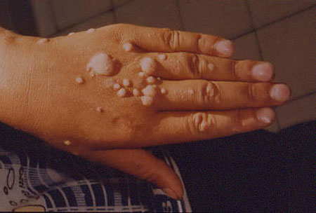 HPV Cutaneous Warts Image obtained from U.S. Department of Veterans Affairs - Image Library [8] (Pediatric AIDS Pictoral Atlas, Baylor International Pediatric AIDS Initiative)