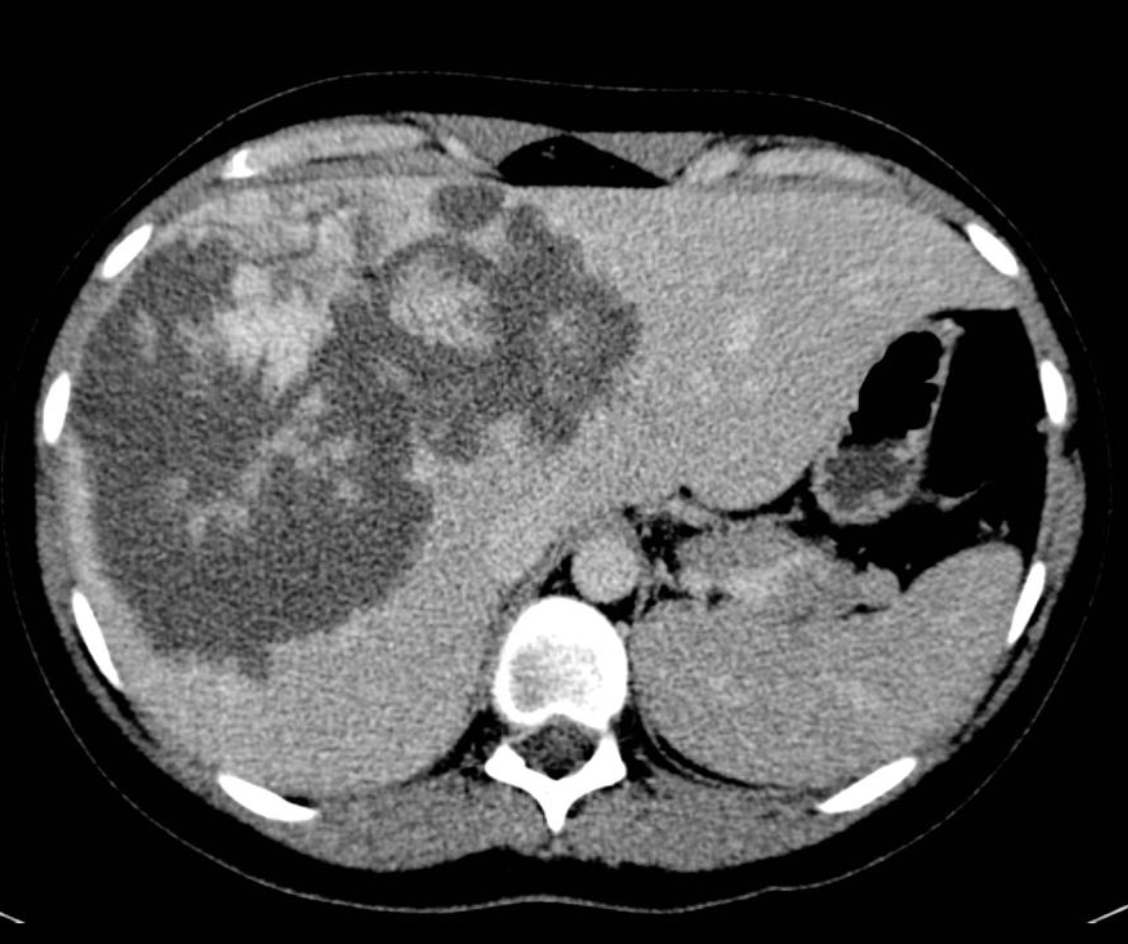 Liver hemangioma: discontinuous, nodular, peripheral enhancement starting in arterial phase