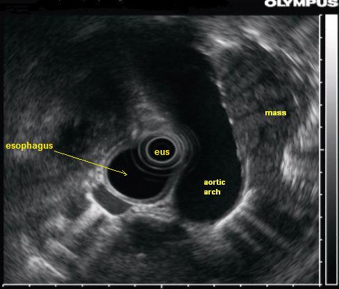 Endoscopic ultrasound: A lung mass which is partially behind the aorta is seen with endoscopic ultrasound