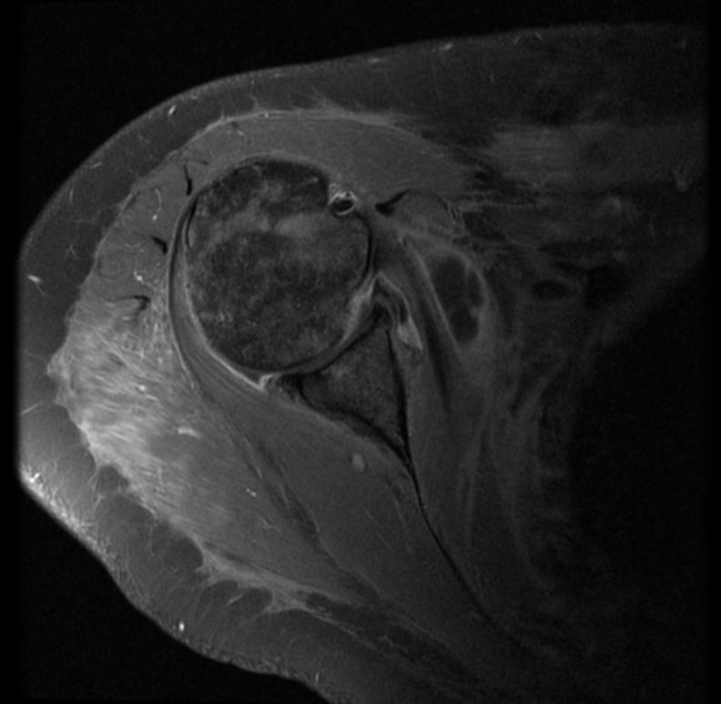 File:Radiation necrosis MRI 004.jpg