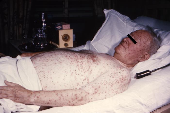 Case of chickenpox. From Public Health Image Library (PHIL). [27]