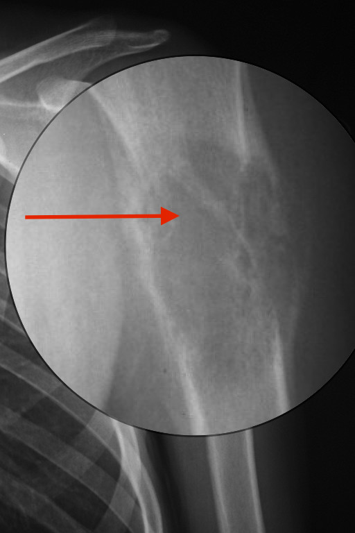 Osteosarcoma with Codman triangles: the tumor is essentially lytic and destructive with irregular, permeative margins, and soft tissue extension (red arrow). Codman triangles (reactive periosteal new bone formation around the edges) are very prominent Adapted from Creative Commons 3.0