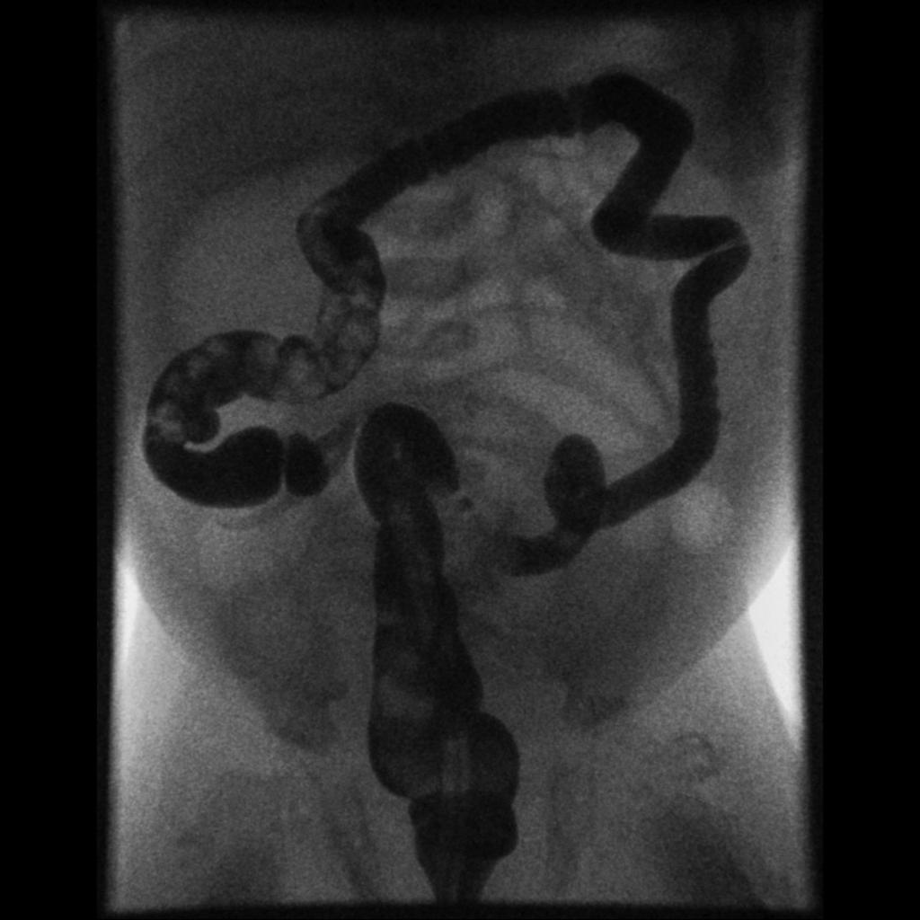 File:Small-bowel-atresia - Case courtesy of A.Prof Frank Gaillard, Radiopaedia.org, rID 5959.jpg