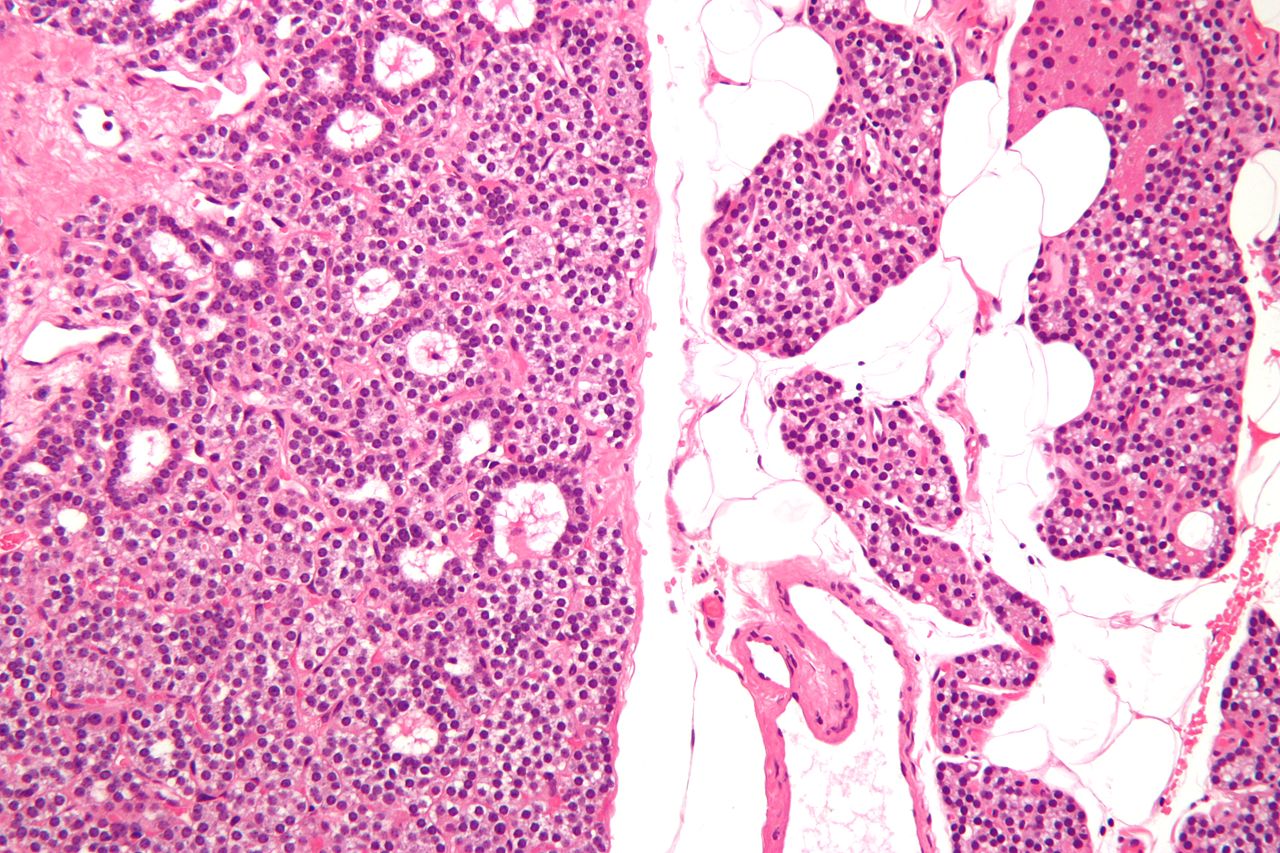 Intermediate/Low magnification micrograph of parathyroid adenoma. H&E stain. Features: Single cell population forming a single mass. Thin capsule. No adipose tissue. +/-Glandular architecture (which may lead to confusion with thyroid tissue). Normal parathyroid gland with prominent adipose tissue is seen on the right of the image.[4]